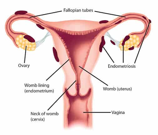 COME VINCERE LA GUERRA CONTRO L’ENDOMETRIOSI